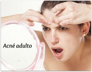 acne-adulto-causas-soluciones